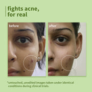 Plum Green Tea Pore Cleansing Face Wash for Oily, Acne Prone, Dry & Combination Skin | with Glycolic Acid | Fight Pimples & Control Excess Oil | Gentle Exfoliating & Non-Drying | Women & Men | 100ml